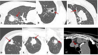 CT radiomics model combined with clinical and radiographic features for discriminating peripheral small cell lung cancer from peripheral lung adenocarcinoma